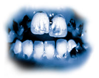 Los ingredientes tóxicos en el meth provocan caries grave conocida como “boca de meth”. Los dientes se vuelven negros, manchados y podridos, frecuentemente hasta el punto en que tienen que sacarse. Los dientes y encías se destruyen en la parte interior, y las raíces se pudren.